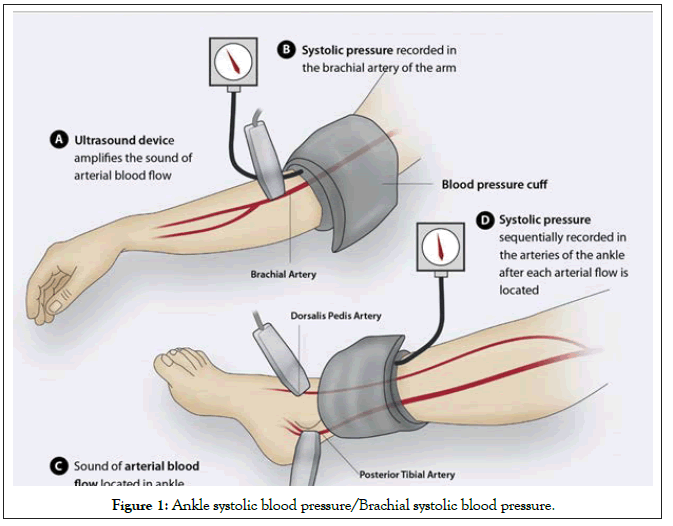 vascular-medicine-surgery-Ankle systolic